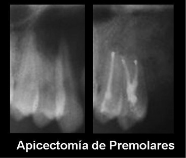 Apicectomía de Premolares