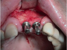 Colocación de dos Implantes  sobre el Injerto cicatrizado 