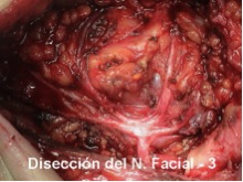 Disección del Nervio Facial (3)