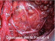 Disección del Nervio Facial (4)