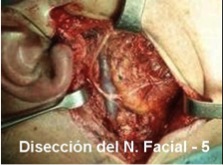 Disección del Nervio Facial (5)