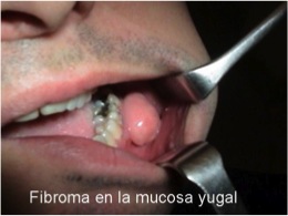Fibroma en la mucosa yugal
