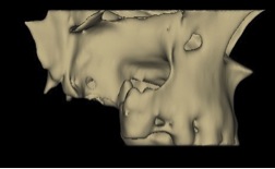 Gran destrucción Maxilar – Scanner 3D