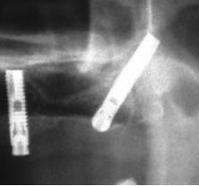 Implante Pterigoideo