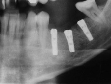 Implantes osteointegrados