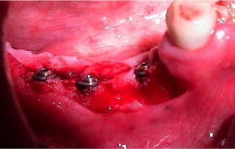 Implantes colocados sobre el injerto de Cresta Iliaca cicatrizado 