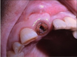 Necrosis de un incisivo dental