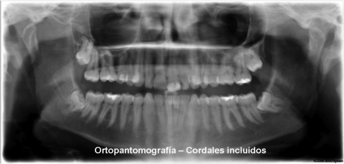 Ortopantomografía-Cordales incluidos
