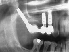 Prótesis dental fijada en un Implante Pterigoideo
