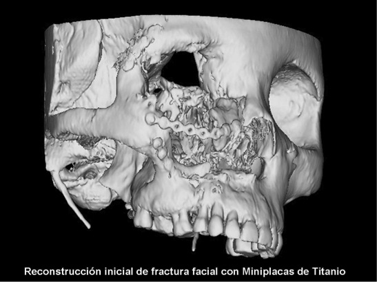 Reconstrucción inicial de fractura facial con Miniplacas de Titanio