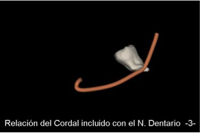 Relación del Cordal Incluido con el Nervio Dentario