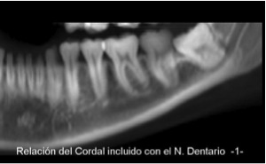 Relación del Cordal Incluido con el Nervio  Dentario