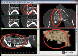 Reparación del defecto maxilar Cicatrización del Injerto Implante Pterigoideo 