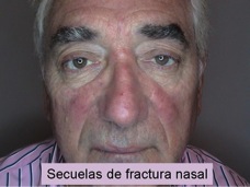 Secuelas de fractura nasal