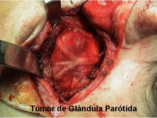 Tumor de Glándula Parótida