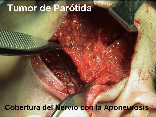 Tumor de Parótida (cobertura del Nervio con la Aponeurosis