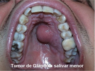 Tumor de glándula salivar menor