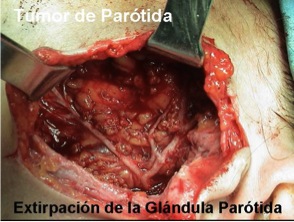 Tumor de Parótida (extirpación de la Glándula Parótida)