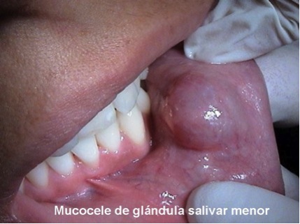 Mucocele de glándula salivar menor